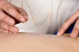 dry needling physio in abbotsford
