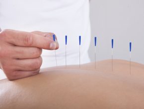 Dry Needling Therapy in Surrey