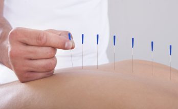 Dry Needling Therapy in Surrey